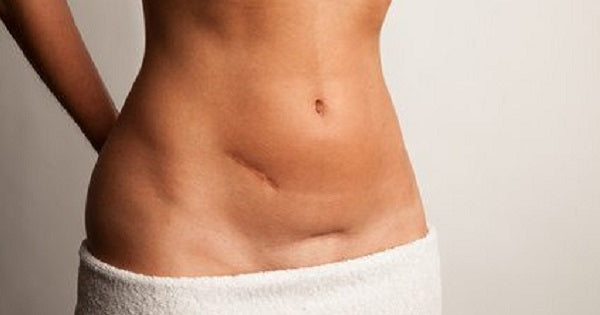 TUMMY TUCKS SCARS TREATMENT: