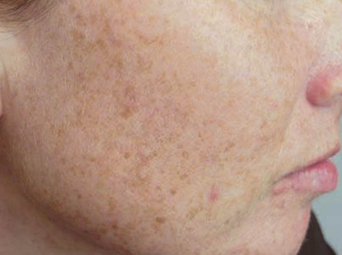 DARK SKIN PATCHES ON ASIAN SKINS!
