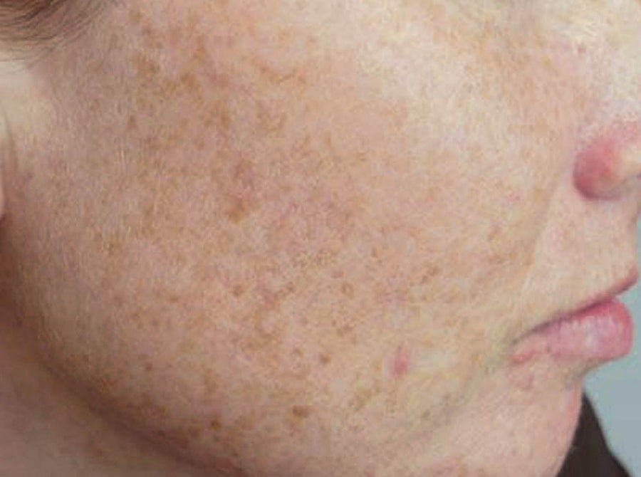 DARK SKIN PATCHES ON ASIAN SKINS!