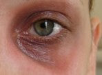 HOW TO TREAT DARK UNDEREYE CIRCLES