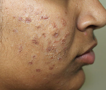 Advanced Scar Treatment for Smooth and Healthy Skin