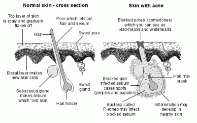 WHAT ARE THE CAUSES OF ACNE?