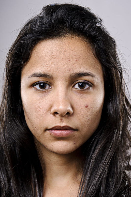 WHAT CAUSES OF ACNE