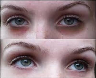 UNDERSTANDING DARK CIRCLES TO IDENTIFY SUITABLE PRODUCT