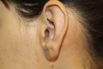 INFLAMMATION IS THE CAUSE OF SCARS