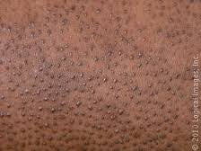 HOW TO TREAT DARK SKIN PATCHES(HYPERPIGMENTATION) DUE TO HYPERKERATITIS PILARIS