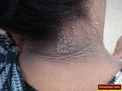 DARK PATCHES (HYPERPIGMENTATION) WITH ACANTHOSIS NIGRICANS
