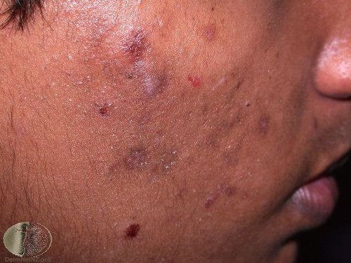 5 TIPS TO CARE FOR BLACK SKIN WITH ACNE