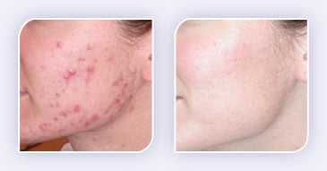 THE BEST TREATMENTS AVAILABLE FOR ACNE OVERVIEW