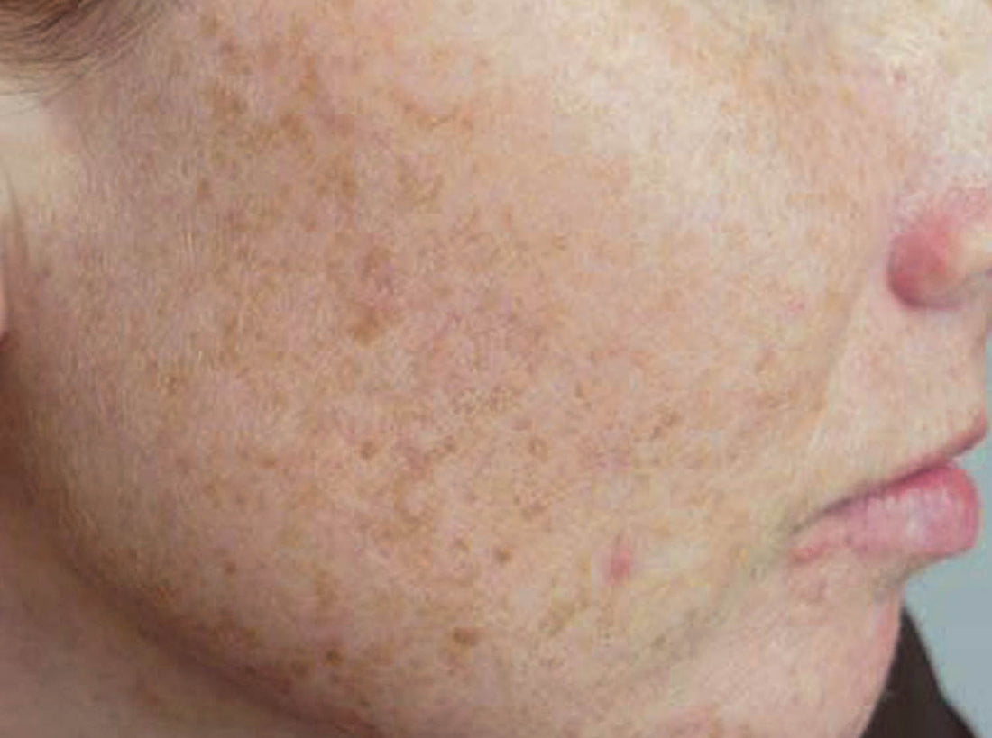 DARK SKIN PATCHES ON ASIAN SKINS!