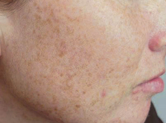DARK SKIN PATCHES ON ASIAN SKINS!