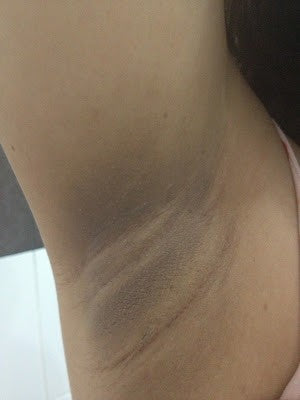 HOW TO LIGHTEN DARK SKIN IN ARMPIT & GROIN AREAS?