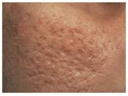 HOW TO GET RID OF ACNE SCARS IN 10 SIMPLE STEPS