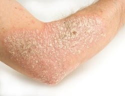 HOW TO TREAT DARK PATCHES (HYPERPIGMENTATION) OF ECZEMA IN DARK SKIN?