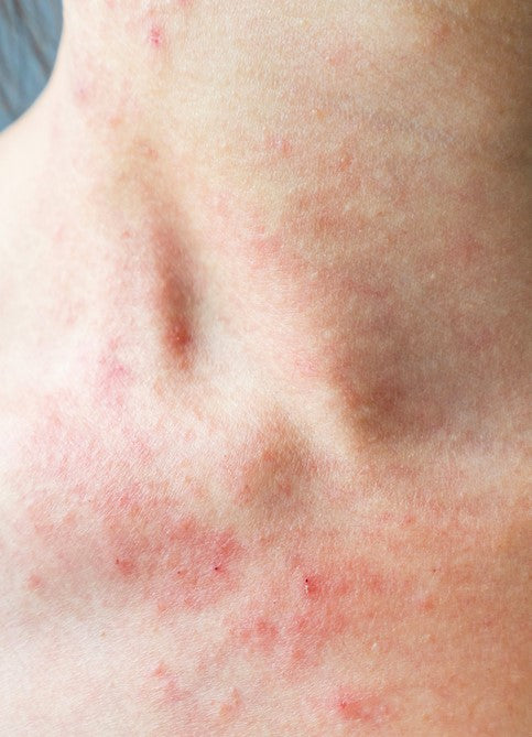 HOW TO TREAT YOUR ECZEMA HYPERPIGMENTATION ON THE BODY