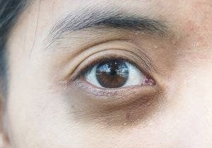 The Ultimate Solution for Dark Circles and Bags
