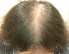 HOW TO PREVENT HAIR LOSS