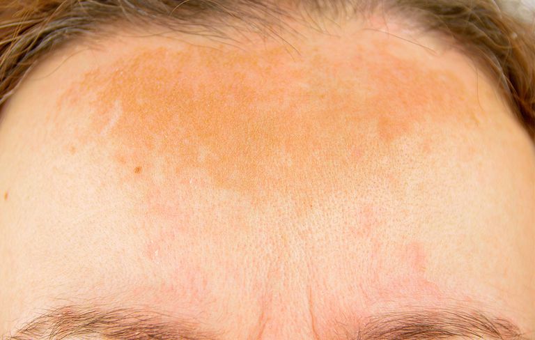 WHAT IS HYPER-PIGMENTATION?