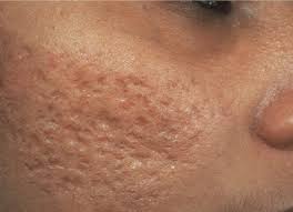 HOW DO YOU DO ATROPHIC SCAR TREATMENT AT HOME?