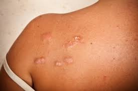 HOW DO YOU TREAT KELOID SCARS?