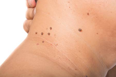 WHAT ARE MOLES?