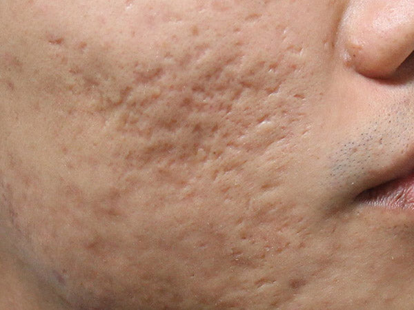 HOW TO GET RID OF ACNE SCARS