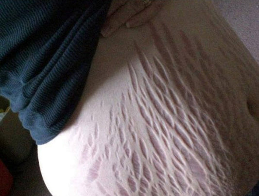 WHAT IS A STRETCH MARK ROLLER?