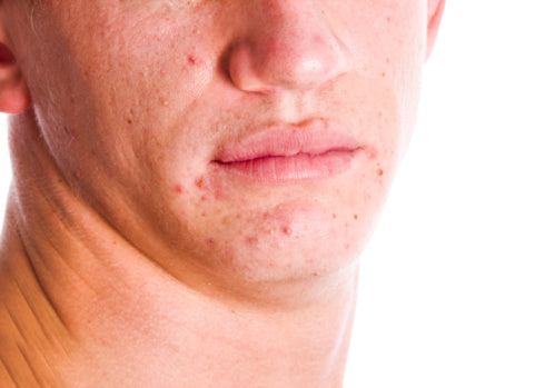 HOW TO TREAT ACNE IN TEENAGERS
