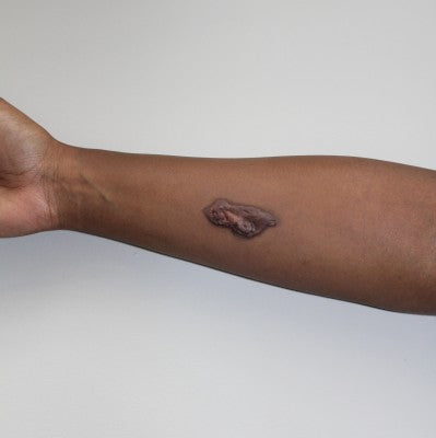 WHICH IS THE BEST SCAR REDUCING CREAM FOR OLD, RESISTANT SCARS?