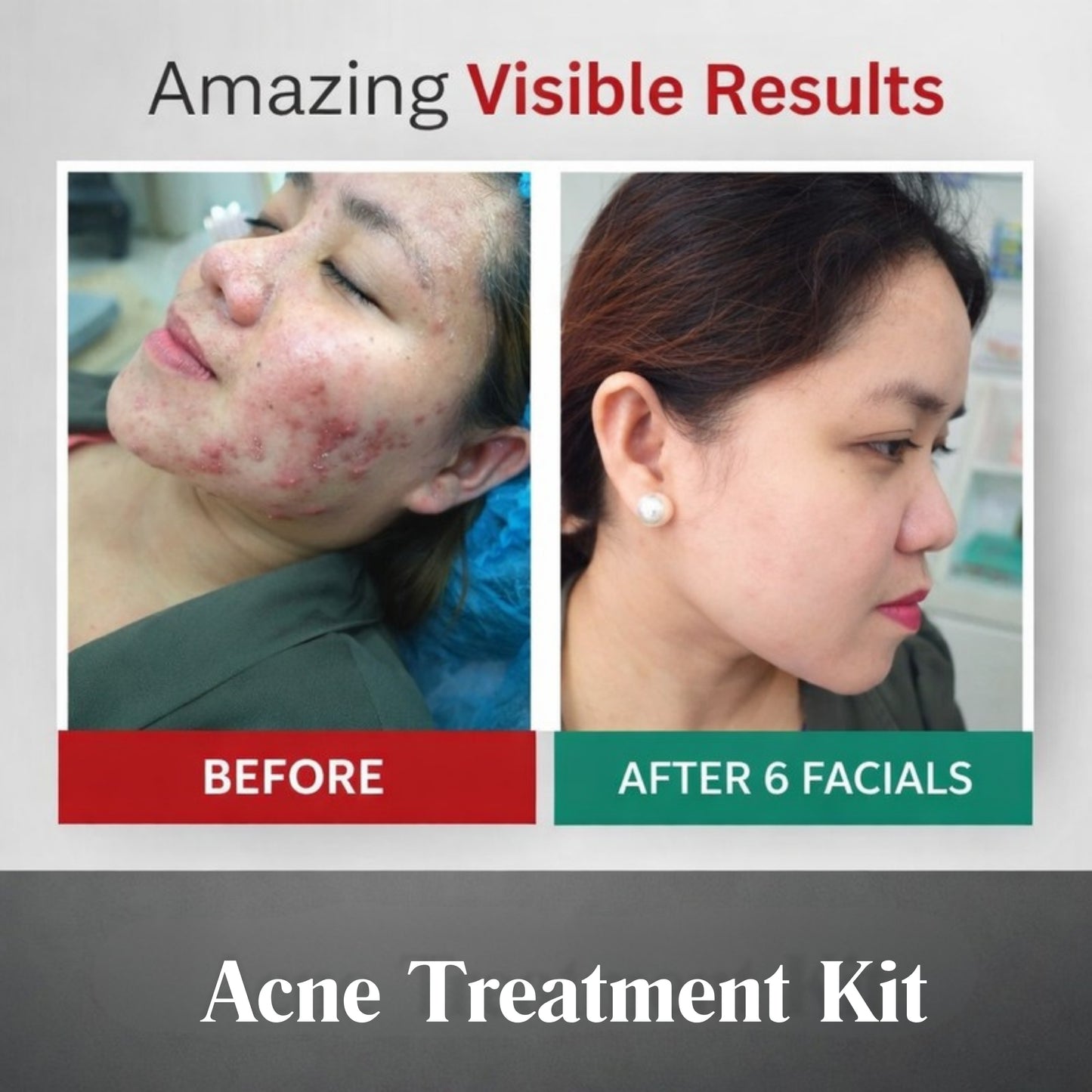 Acne Treatment Kit