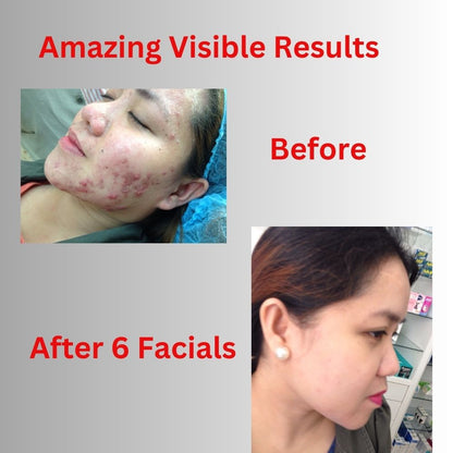 Acne Treatment Kit
