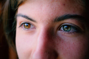 pigmentation eyes